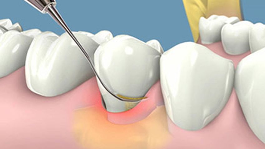 lay-cao-rang-mien-phi-2