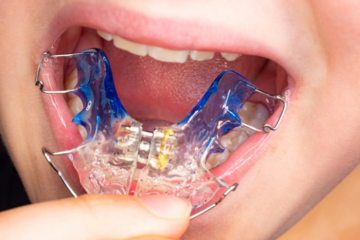 Tác hại của nong hàm là gì? Có ảnh hưởng đến sức khỏe không?