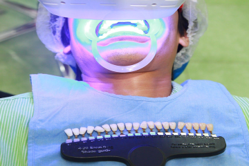 Tẩy trắng răng bằng đèn Plasma có tốt không?