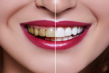 Tẩy trắng răng có bị vàng lại không? Có tẩy trắng tiếp được không? 