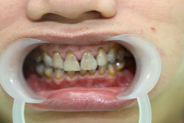 Tẩy trắng răng nhiễm kháng sinh có được không? 