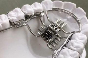 Thế nào là nong hàm bằng dây cung? và các kỹ thuật nong hàm hiện nay