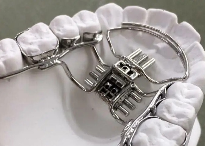 Thế nào là nong hàm bằng dây cung? và các kỹ thuật nong hàm hiện nay