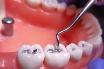 Thế nào là răng sâu vào tủy? Quy trình hàn răng sâu vào tủy