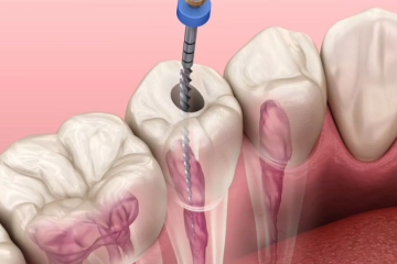 Tìm hiểu phương pháp điều trị tủy răng bằng máy Protaper