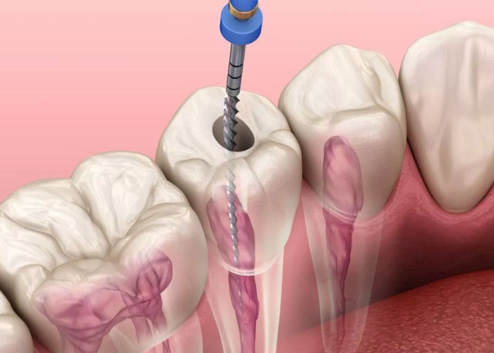 Tìm hiểu phương pháp điều trị tủy răng bằng máy Protaper
