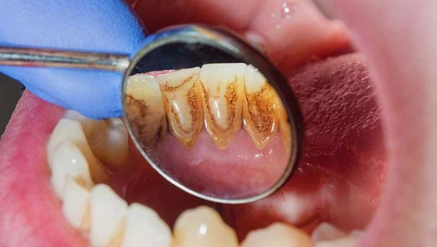 tim-hieu-ve-chi-phi-dieu-tri-viem-nha-chu-1