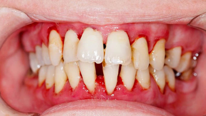 tim-hieu-ve-chi-phi-dieu-tri-viem-nha-chu-2