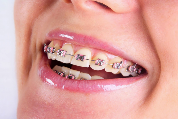 Top 5 các loại niềng răng phổ biến hiện nay? Loại nào tốt nhất