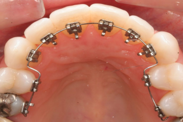 Ưu và nhược điểm của niềng răng mặt trong