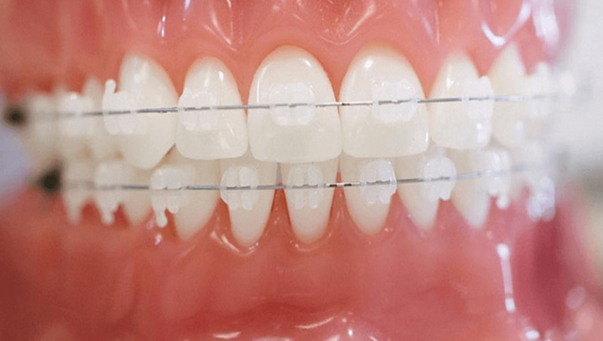 Ưu và nhược điểm của phương pháp niềng răng mắc cài sứ 