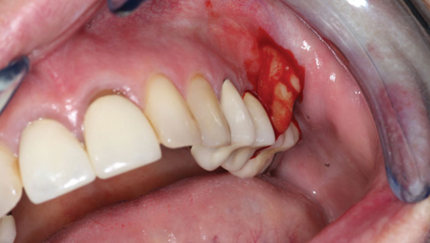 viem-loi-co-mu-la-gi-cach-dieu-tri-viem-loi-co-mu-1