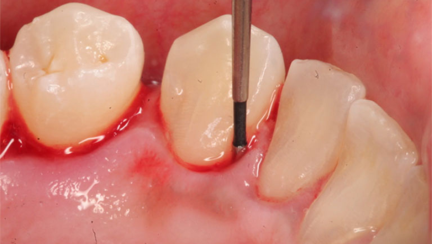 viem-loi-co-mu-la-gi-cach-dieu-tri-viem-loi-co-mu-2