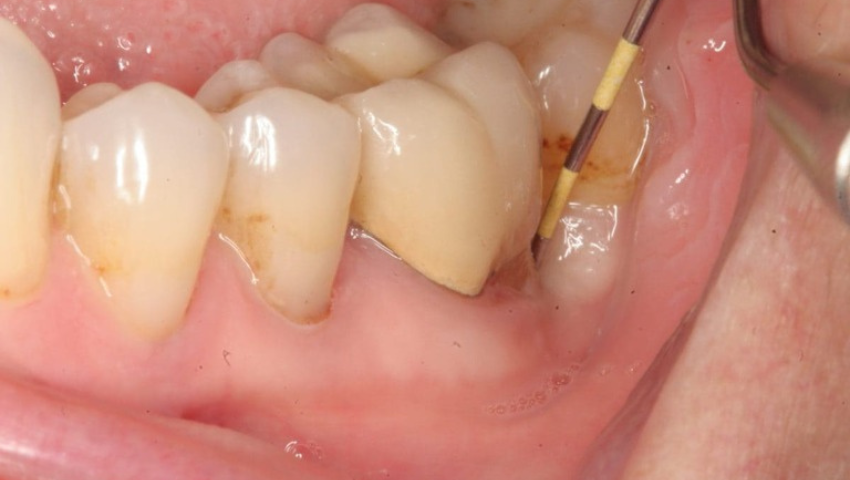 viem-loi-co-mu-la-gi-cach-dieu-tri-viem-loi-co-mu-3