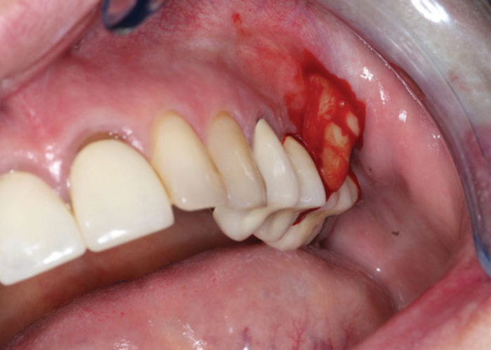 Viêm lợi có mủ là gì? Cách điều trị viêm lợi có mủ