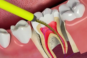 Viêm tủy răng là gì? Các phương pháp điều trị viêm tủy răng