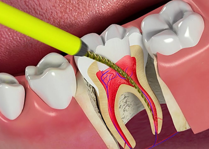 Viêm tủy răng là gì? Các phương pháp điều trị viêm tủy răng