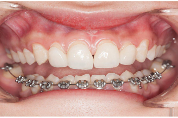 Niềng răng 1 hàm giá bao nhiêu tiền? Những trường hợp niềng răng một hàm