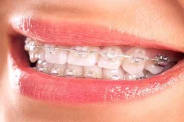 Niềng răng là gì? Có nên niềng răng không?