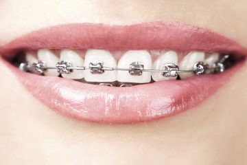 Niềng răng mắc cài kim loại là gì? Quy trình niềng răng