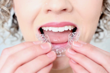 Chi phí niềng răng trong suốt tại hà nội bao nhiêu? Có đắt không? 