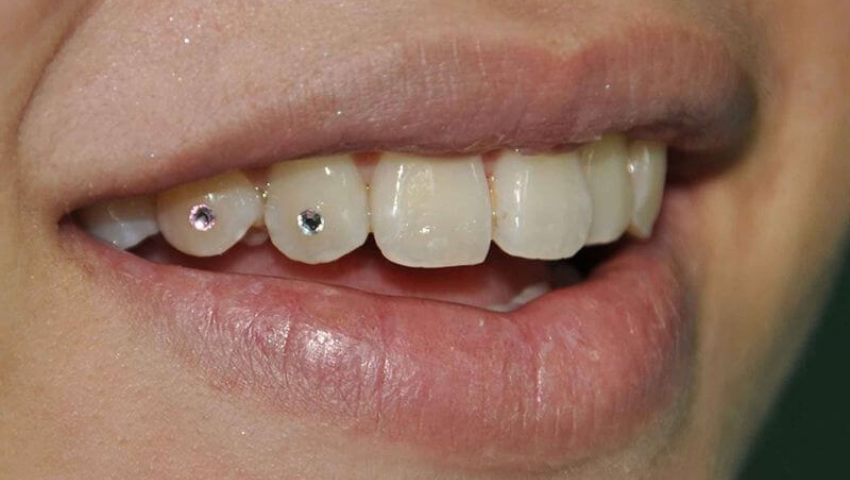 dinh-da-vao-rang-gia-bao-nhieu-2