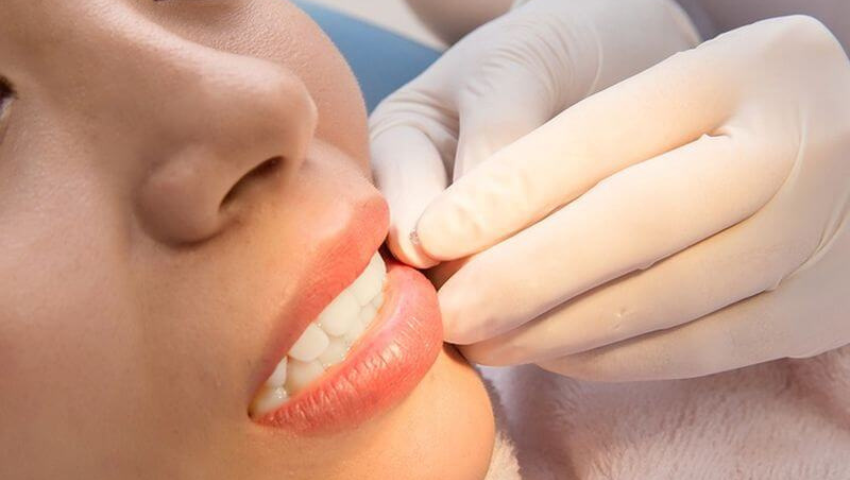 dinh-da-vao-rang-gia-bao-nhieu-3