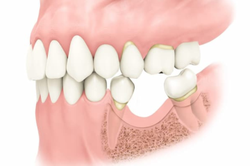 Ghép xương cấy Implant có đau không? Có an toàn không?