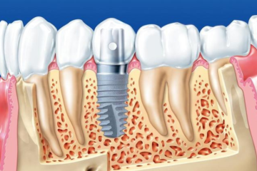 Cấy ghép xương Implant cần lưu ý những gì?