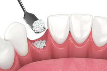 Tìm hiểu ghép xương nhân tạo giá bao nhiêu?