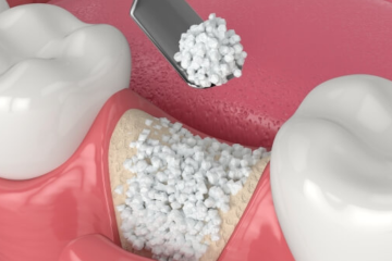 Ghép xương ổ răng là gì? Quy trình thực hiện