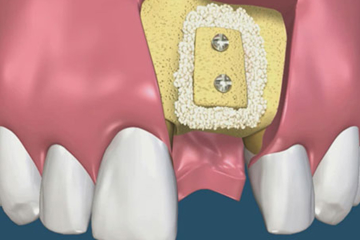 Ghép xương răng bao lâu thì lành? Có đau không?