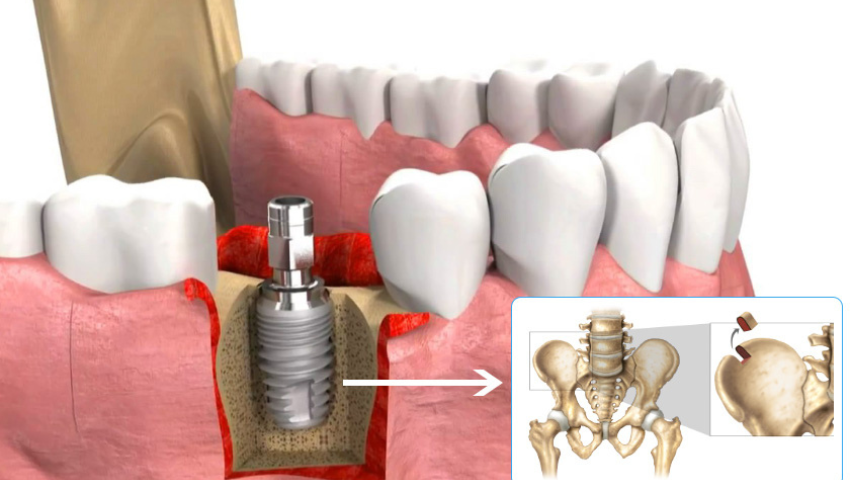 Ghép xương tự thân là gì? Lợi ích ghép xương tự thân
