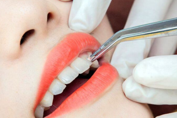 Điểm danh những lưu ý khi gắn đá lên răng