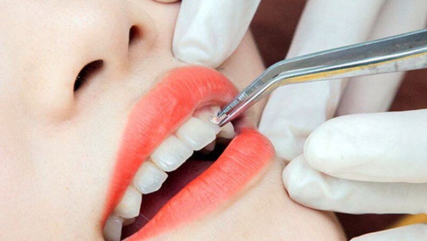 luu-y-khi-gan-da-len-rang-1