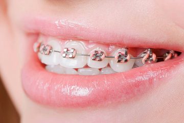 Tham khảo chi phí niềng răng hàm trên giá bao nhiêu?