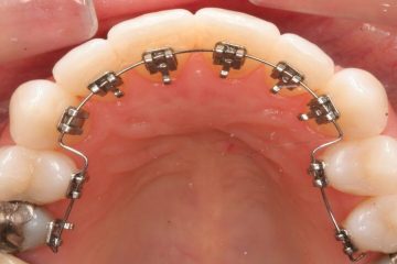 Niềng răng mắc cài trong là gì? Vì sao chi phí lại cao