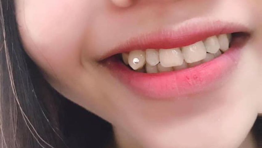 quy-trinh-gan-da-len-rang-1