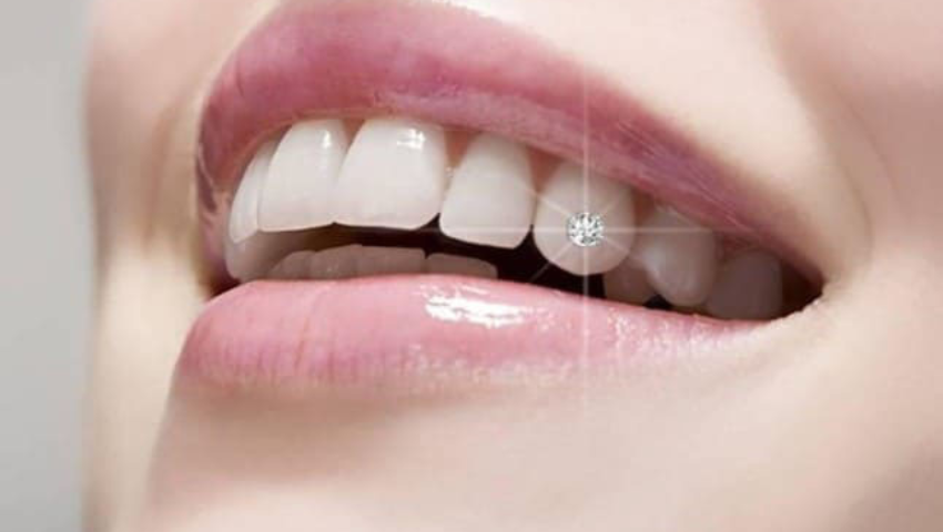 quy-trinh-gan-da-len-rang-2