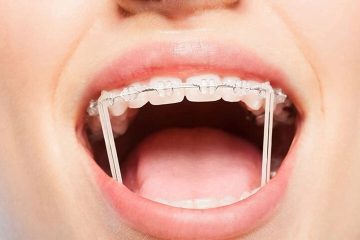 Thun niềng răng có vai trò gì? Những loại thun niềng phổ biến nhất