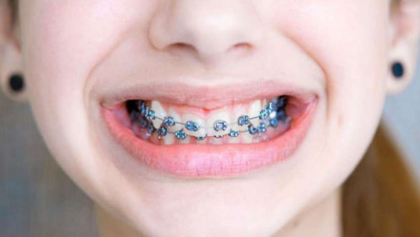 25-tuoi-nieng-rang-duoc-khong-2