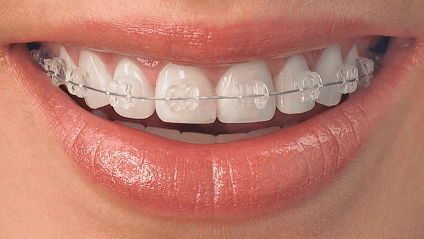 30-tuoi-co-nieng-rang-duoc-khong-2