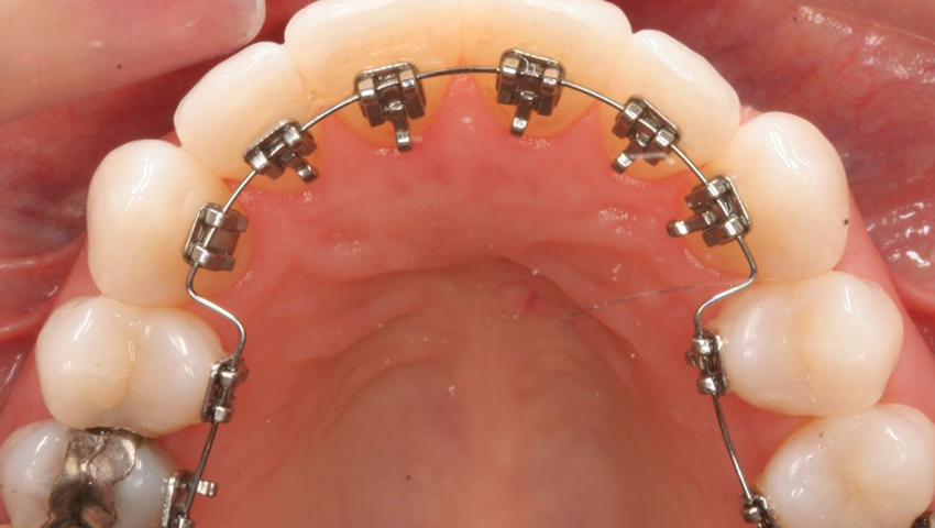 30-tuoi-co-nieng-rang-duoc-khong-3