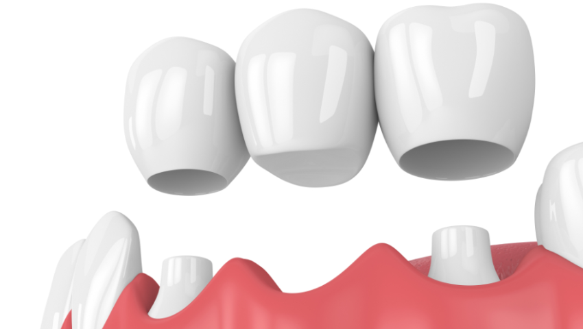 Tư vấn: Bắc cầu răng sứ có bền không? Thời gian sử dụng bao lâu