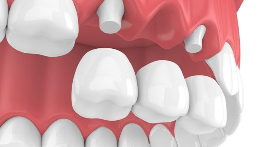 bac-cau-rang-su-co-ben-khong-3