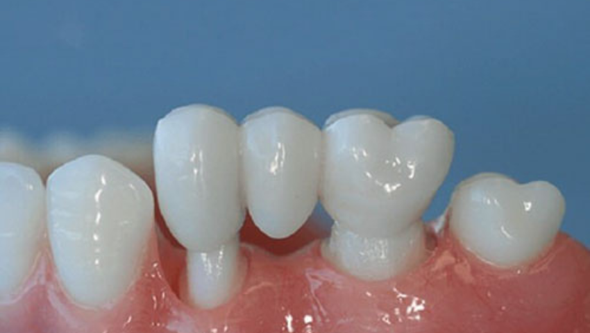 Tư vấn: Cầu răng sứ giá bao nhiêu tiền?