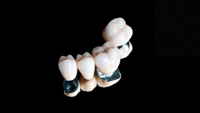 Thế nào là cầu răng sứ titan? Những trường hợp nào nên dùng