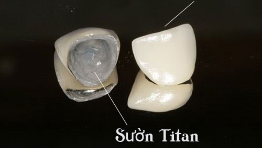 cau-rang-su-titan-3