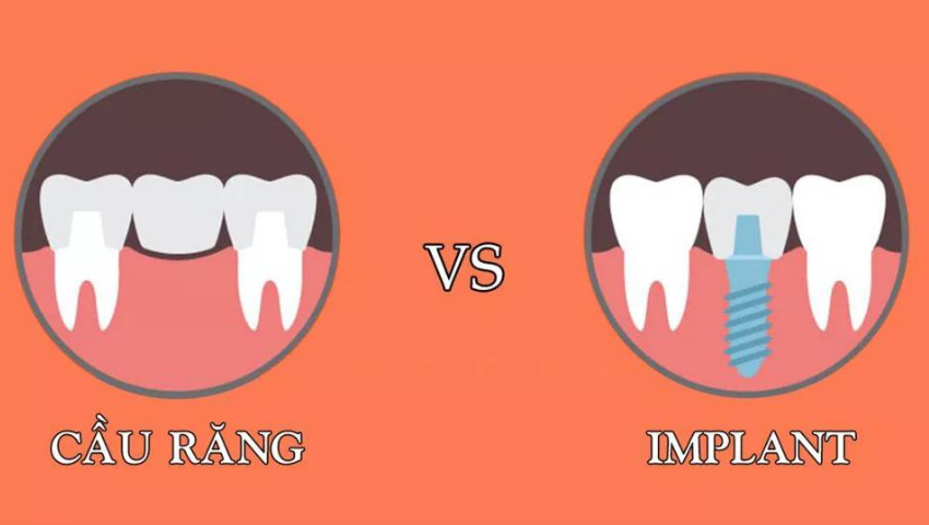 So sánh ưu và nhược điểm của bắc cầu răng sứ và implant