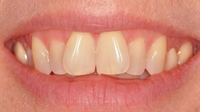 Chỉnh răng mọc lệch không cần niềng có hiệu quả không?